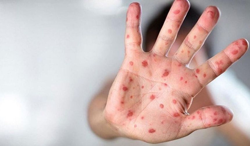 Maymun Çiçeği Alarmı: Vakalarda Bir Haftada  yüzde 63 Artış!